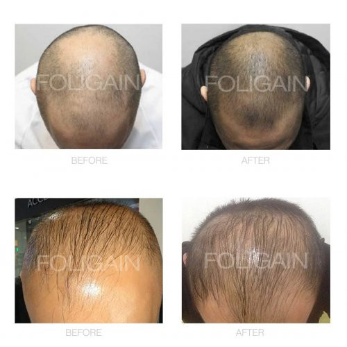 Foligain Advanced Hair Regrowth Treatment Foam For Men with Minoxidil 5 ...