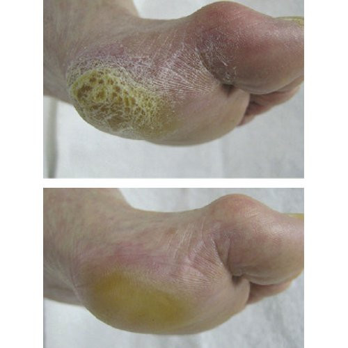 Footlogix Callus Softener 180ml