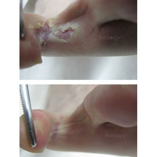 Footlogix Peeling Skin Formula Mousse 125ml