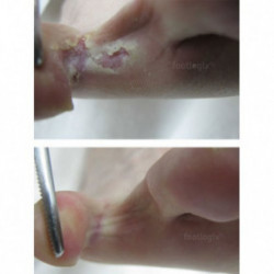 Footlogix Peeling Skin Formula Mousse 125ml